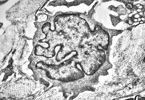 F, 36y. | generalized eruptive histiocytoma - cerebriform nucleus - Sezary cell F, 36y. | generalized eruptive histiocytoma - cerebriform nucleus - Sezary cell